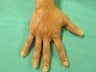 Hand Rejuvenation