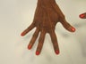 Hand Rejuvenation