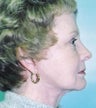 Facelift
