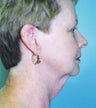 Facelift