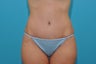 Tummy Tuck for Bikini Season in a 38-year-old mom