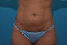 Tummy Tuck for Bikini Season in a 38-year-old mom