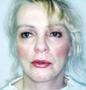 Female patient who underwent a lip augmentation 