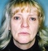Female patient who underwent a lip augmentation 