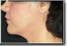 Chin Augmentation