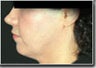 Chin Augmentation