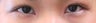 Bilateral Asian Eyelid w Z-plasty Surgery