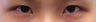 Bilateral Asian Eyelid w Z-plasty Surgery