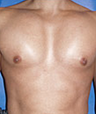 Pec Implants