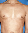 Pec Implants