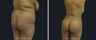 Liposuction