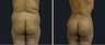 Liposuction