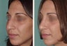 Rhinoplasty