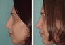 Rhinoplasty