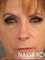Female Revision Rhinoplasty 