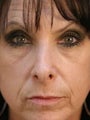 Female Revision Rhinoplasty 
