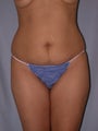 Tummy Tuck