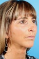 Facelift