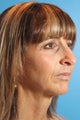 Facelift
