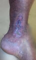 55 year old man with chronic venous stasis ulcer