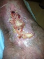 55 year old man with chronic venous stasis ulcer