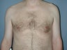 Male Patient Gynecomastia