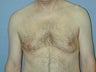 Male Patient Gynecomastia