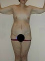 Body Lift
