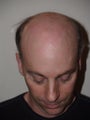 Before and after surgical hairline excision with tissue expansion, to repair prior multiple hairline plug grafts       