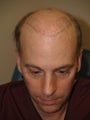 Before and after surgical hairline excision with tissue expansion, to repair prior multiple hairline plug grafts       