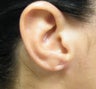 Earlobe Repair