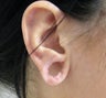 Earlobe Repair