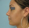 Rhinoplasty