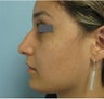 Rhinoplasty