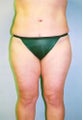 42 year old Female underwent tummy tuck and liposuction