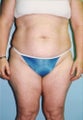 42 year old Female underwent tummy tuck and liposuction