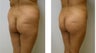 Brazilian Butt Lift 