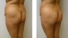 Brazilian Butt Lift 