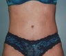 44-Year Old Female Tummy Tuck