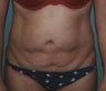 44-Year Old Female Tummy Tuck
