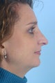 Rhinoplasty