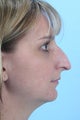 Rhinoplasty