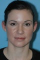 Rhinoplasty