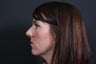 Rhinoplasty