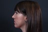 Rhinoplasty