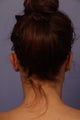 Otoplasty