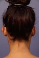 Otoplasty