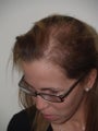 Before and After Hair Transplant Procedure