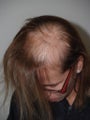 Before and After Hair Transplant Procedure