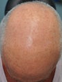Male Patient Treated for Significant Sun Damage on Scalp